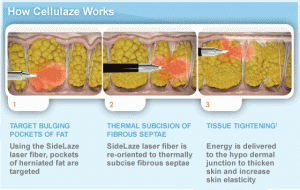 Anti-Cellulite_how-it-works