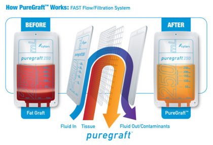 puregraft-process